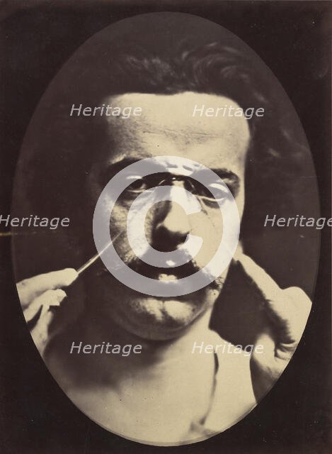 Figure 16: Expression of severity , 1854-56, printed 1862. Creators: Duchenne de Boulogne, Adrien Alban Tournachon.