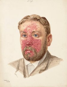 The head of a man with skin disease, July 1889. Creator: W Toogood Hill.
