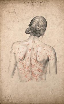 Back of a woman suffering from a rash of sores, 1855. Creator: Christopher D'Alton.