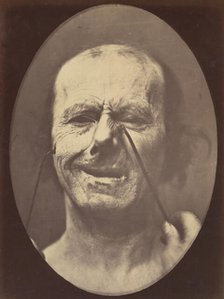 Figure 53: Whimpering and false laughter, 1854-56, printed 1862. Creators: Duchenne de Boulogne, Adrien Alban Tournachon.