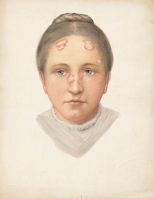 The head of a young woman with loss of skin on her forehead and nose, (1900?). Creator: Jonathan Hutchinson.