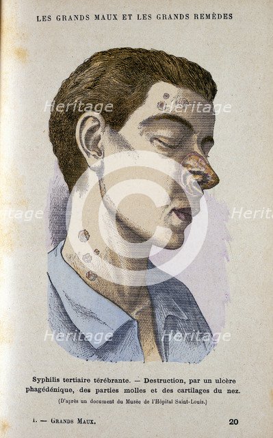 Symptoms of the tertiary phase of syphilis, c19th century. Artist: Unknown