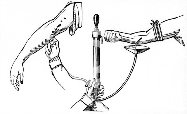 Person-to person blood transfusion, 1833. Artist: Unknown