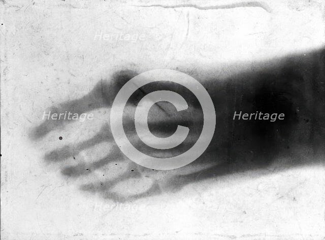 The bones of a pantomime artist's foot, viewed through x-ray; revealing a needle by one of..., 1896. Creator: Unknown.