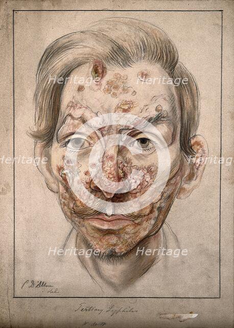 Head of a man with a syphilitic lesions affecting his face, 1874. Creator: Christopher D'Alton.