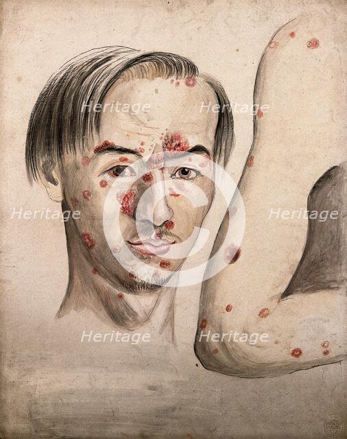 Head of a man with a severe disease affecting his face; and a section of diseased arm, 1800-1899. Creator: Christopher D'Alton.