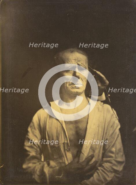 Spasm of m. corrugator supercilii under very strong light (left); A relaxed face..., 1854-1855. Creator: Duchenne de Boulogne.