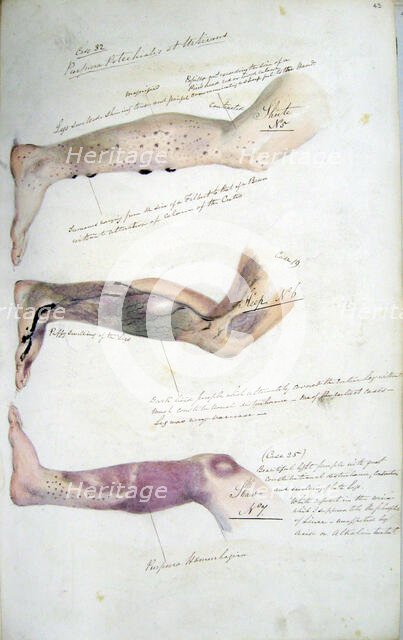 The effects of scurvy, February 1841. Creator: Henry Walsh Mahon.