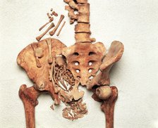 The pelvis of a young Medieval woman. Artist: Unknown