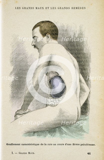 Typical enlarged spleen of a Malaria patient, c1890. Artist: Unknown