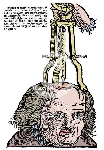 Trephination, 1593. Artist: Unknown.
