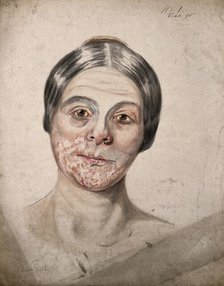 Head of a woman with a severe disease affecting her face, 1800-1899. Creator: Christopher D'Alton.