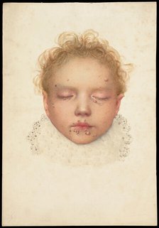 Head of a child with closed eyes and skin disease on the face, 1892. Creator: Unknown.