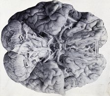 Friern Hospital, London: a diseased brain, viewed from above, 1890/1910. Creator: Unknown.
