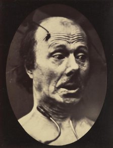 Figure 60: Fright, 1854-56, printed 1862. Creators: Duchenne de Boulogne, Adrien Alban Tournachon.