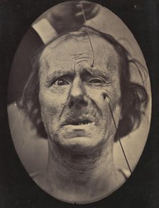 Figure 49: Painful weeping and forward looking., 1854-56, printed 1862. Creators: Duchenne de Boulogne, Adrien Alban Tournachon.