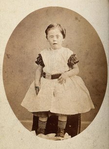 A girl with Down's syndrome, sitting, wearing striped socks, c1890s. Creator: Joseph Arthur Baldry.
