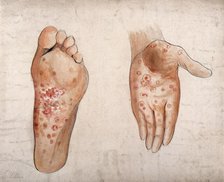 Diseased tissue on the palm of the hand and sole of the foot of a man, (1853?). Creator: Christopher D'Alton.