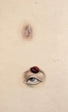 A section of a child's diseased forehead (detail); and a child's diseased eyebrow..., 1829. Creator: Unknown.