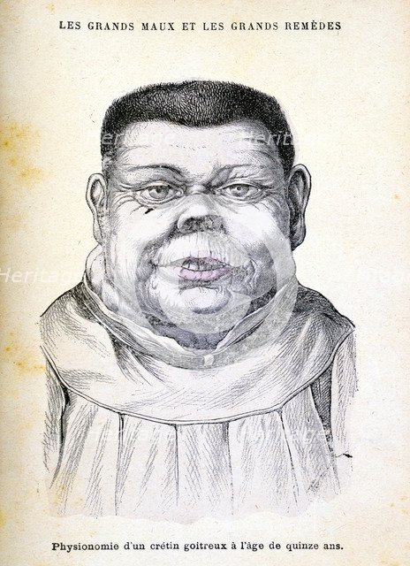 Cretin aged 15, c1890. Artist: Unknown