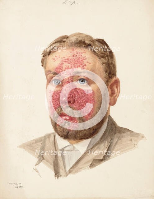 The head of a man with skin disease, July 1889. Creator: W Toogood Hill.