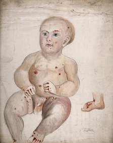 A three month old baby boy with diseased skin and sores on his face and body..., between 1800 & 1899 Creator: Christopher D'Alton.