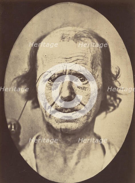 Figure 12: A study of the contraction of and the expression produced by t..., 1854-56, printed 1862. Creators: Duchenne de Boulogne, Adrien Alban Tournachon.