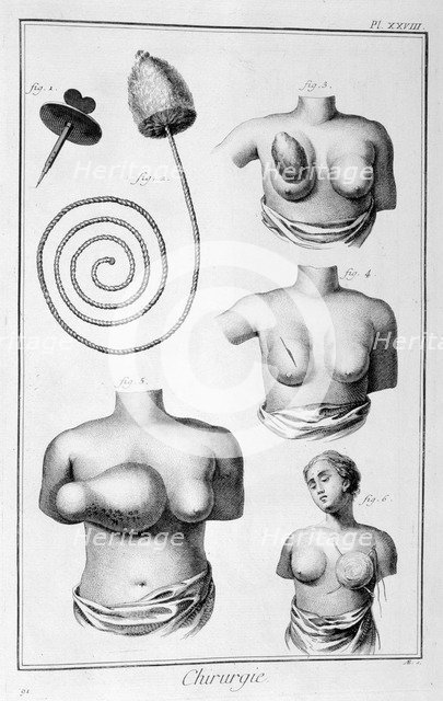 Breast surgery, 1751-1777. Artist: Unknown