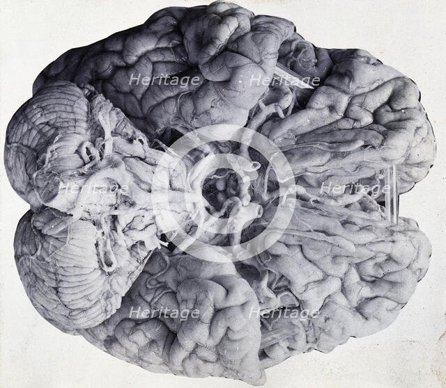 Friern Hospital, London: a diseased brain, viewed from above, 1890/1910. Creator: Unknown.