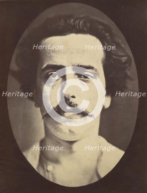 Figure 4: The face in repose of a young man , 1854-56, printed 1862. Creators: Duchenne de Boulogne, Adrien Alban Tournachon.