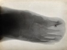 The bones of a foot, possibly with leprosy, viewed through x-ray, 1896.