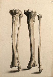 Tibia and fibula bones, 1830-1835. Creator: Unknown.