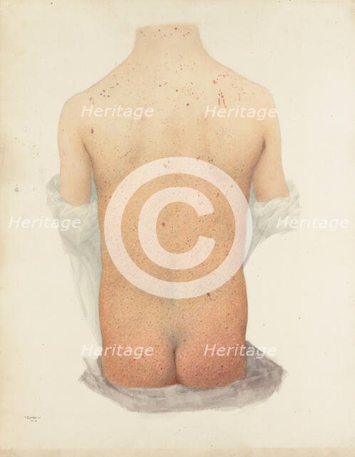 Back of a boy with skin disease, 1891. Creator: W Toogood Hill.