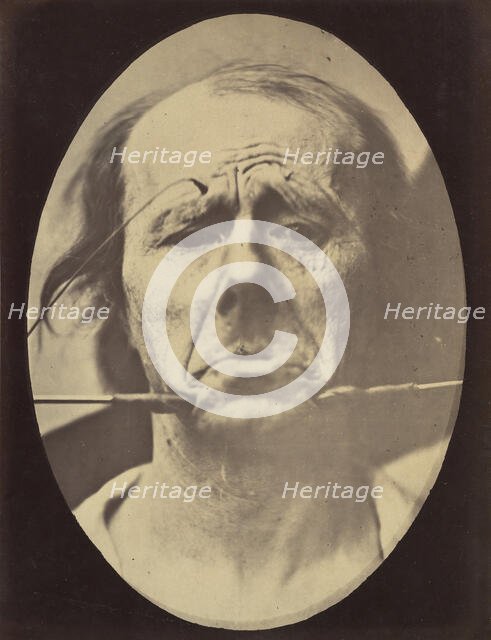 Figure 45: Pain and despair. , 1854-56, printed 1862. Creators: Duchenne de Boulogne, Adrien Alban Tournachon.