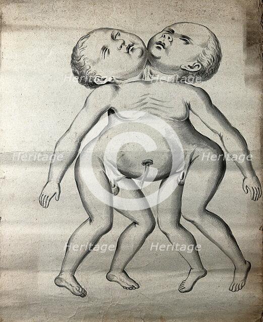 Male conjoined twins joined at the neck and chest; anterior view, 1900. Creator: Unknown.