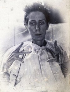 Friern Hospital, London: a woman suffering from mania, with forearm, hand and finger..., 1890/1910. Creator: Unknown.