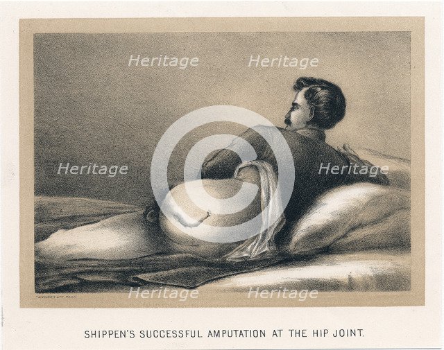 'Shippen's Successful Amputation at the Hip Joint', American Civil War, 1865. Artist: Unknown
