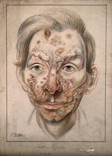 Head of a man with a syphilitic lesions affecting his face, 1874. Creator: Christopher D'Alton.