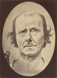 Figure 21: Painful recollection and recollection or calling something to ..., 1854-56, printed 1862. Creators: Duchenne de Boulogne, Adrien Alban Tournachon.