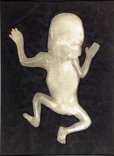 Degree of Ossification of a Five-Month-Old Fetus (Degré d'ossification d'un Foetus de cinq mois), 18 Creator: Unknown.