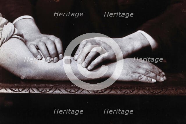 Two hands held on either side of a dark mark on a forearm, to demonstrate...., c1920s. Creator: Unknown.