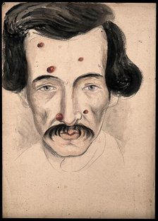 Head of a man with a disease affecting his face, 1800-1899. Creator: Christopher D'Alton.
