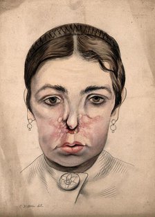 Head of a girl with a severe disease affecting her nose, 1869. Creator: Christopher D'Alton.