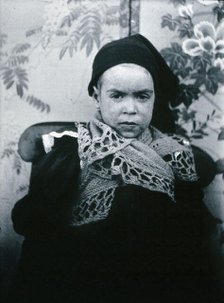 Gloucester smallpox epidemic, 1896: a child of the Beard family, as a convalescent smallpox..., 1896 Creators: HCF of Gloucester, Unknown.