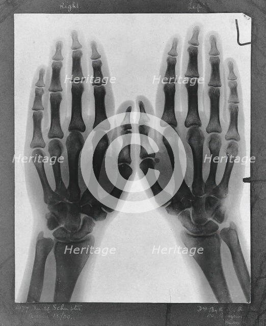 Two hands, viewed through x-ray, 1896.