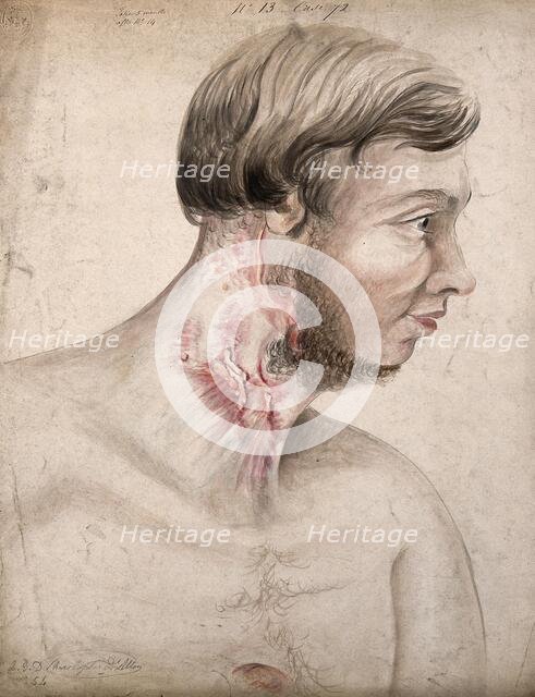 Head and chest of a man with a disease affecting his neck, seen in profile, 1856. Creator: Christopher D'Alton.