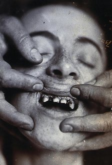 Friern Hospital, London: a young child with rotten teeth, 1890/1910. Creator: Unknown.