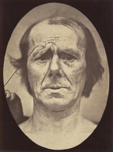 Figure 19: Suffering , 1854-56, printed 1862. Creators: Duchenne de Boulogne, Adrien Alban Tournachon.