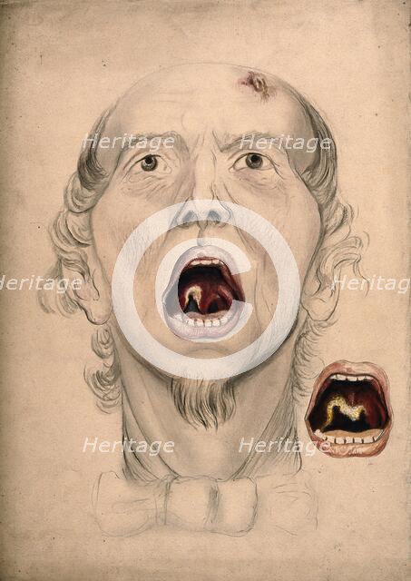 The face of a man, with mouth open wide, displaying a diseased area of tissue on the soft..., 1866. Creator: Christopher D'Alton.