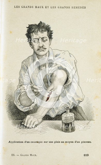 Painting a wound with an antiseptic solution, c1890. Artist: Unknown